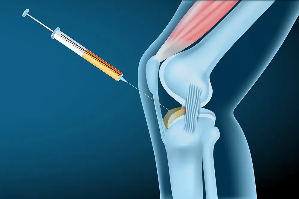 PRP-Therapie am Knie