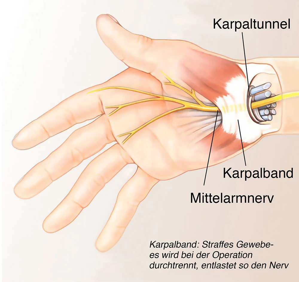 Karpaltunnel Infografik