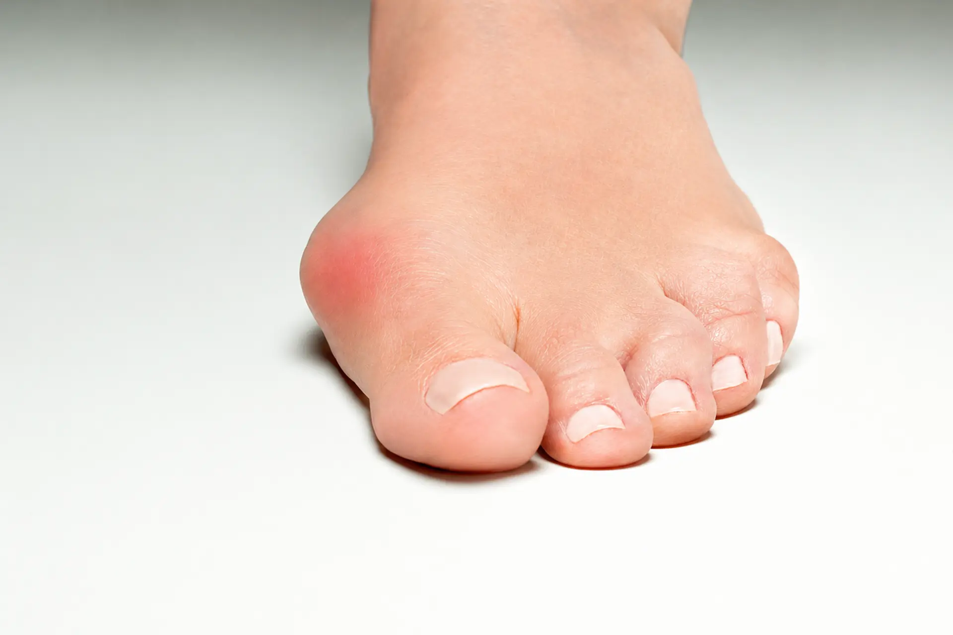 Hallux Valgus: Der Ballen, den viele jahrelang ignorieren