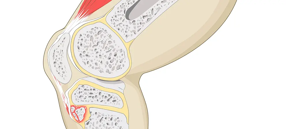 Morbus-Osgood-Schlatter_992x450.webp